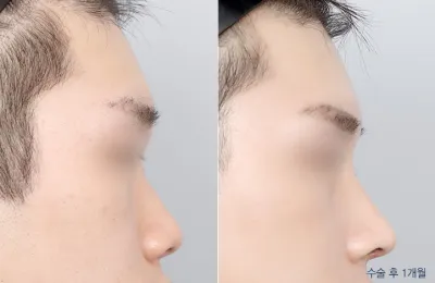 Before & After