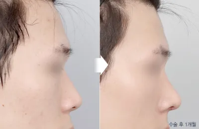 Before & After
