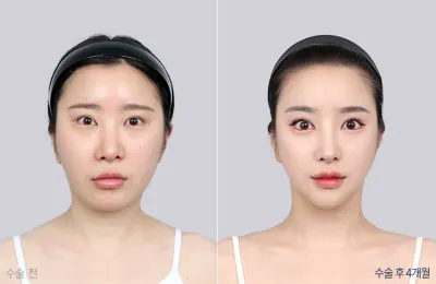 Before & After