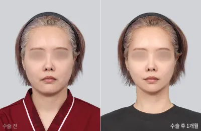 Before & After