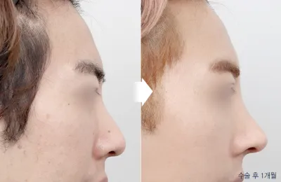 Before & After