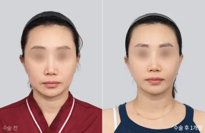 Before & After