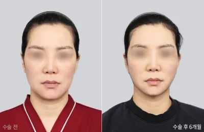 Before & After
