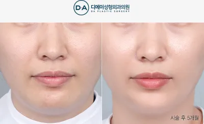 Before & After
