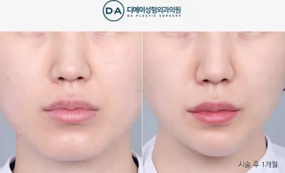 Before & After