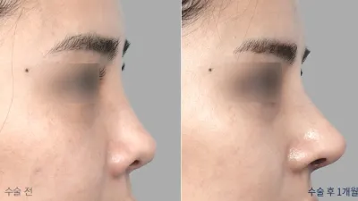 Before & After