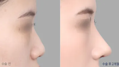 Before & After