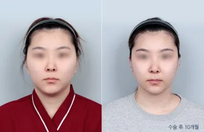 Before & After