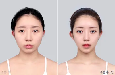 Before & After
