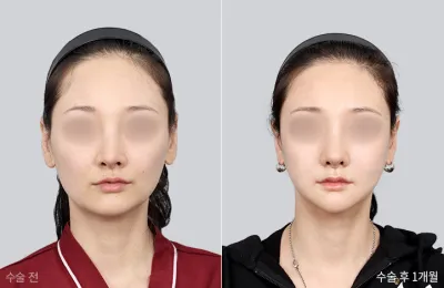 Before & After