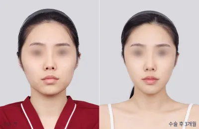 Before & After