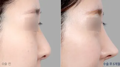 Before & After