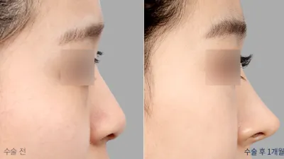 Before & After