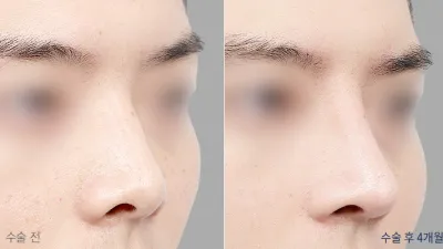 Before & After