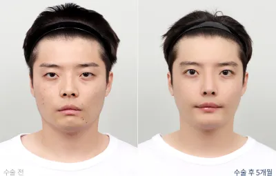 Before & After