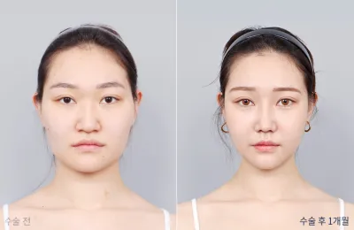 Before & After