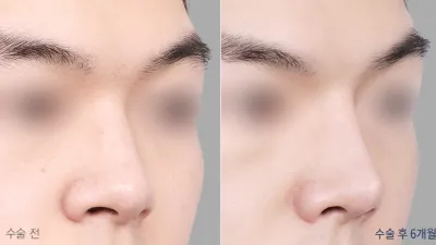 Before & After