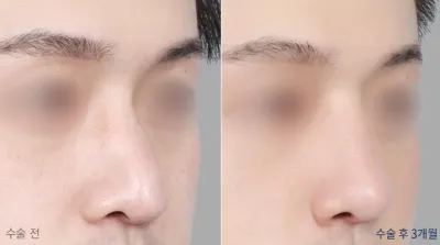 Before & After