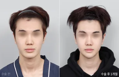 Before & After