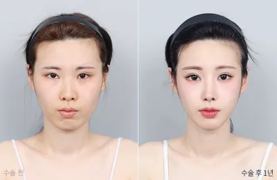Before & After