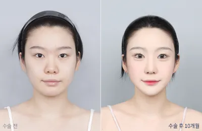 Before & After