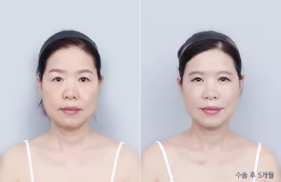 Before & After
