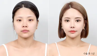Before & After