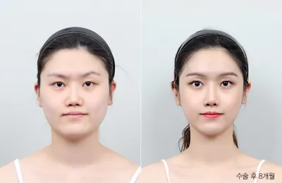 Before & After