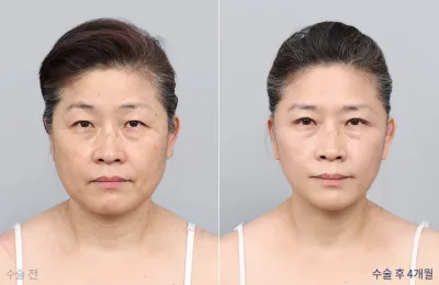 Before & After