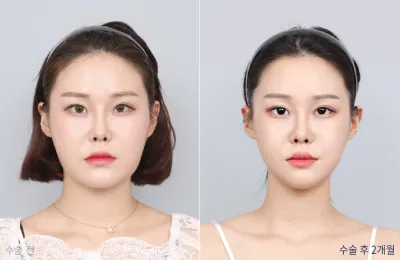 Before & After
