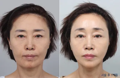 Before & After