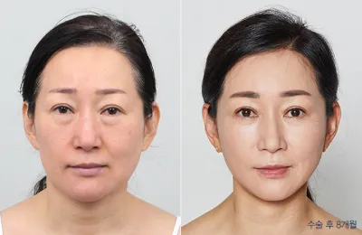 Before & After