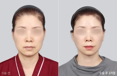 Before & After