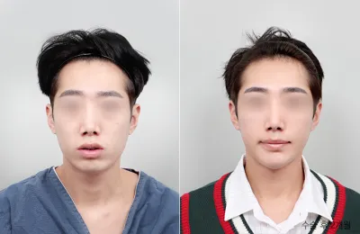 Before & After