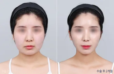 Before & After