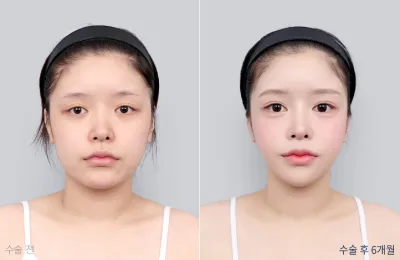 Before & After