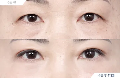 Before & After