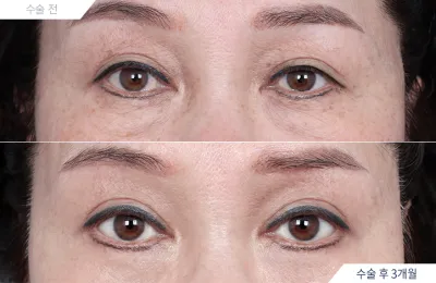 Before & After
