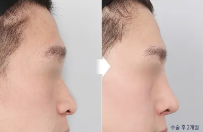 Before & After