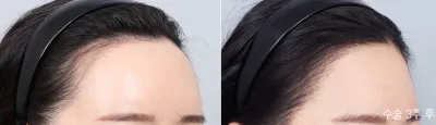 Before & After