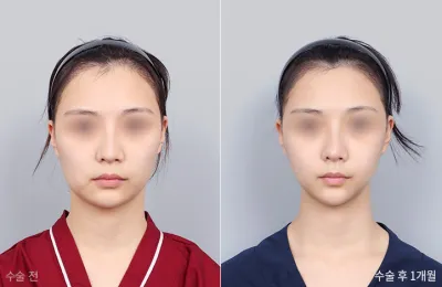 Before & After