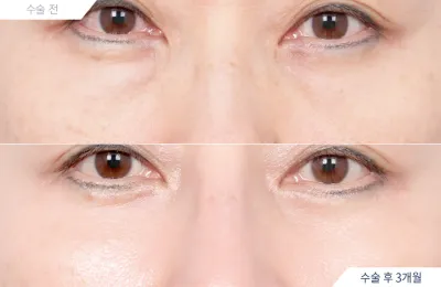Before & After