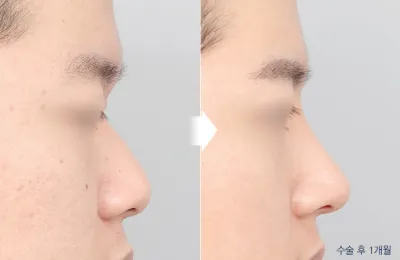Before & After