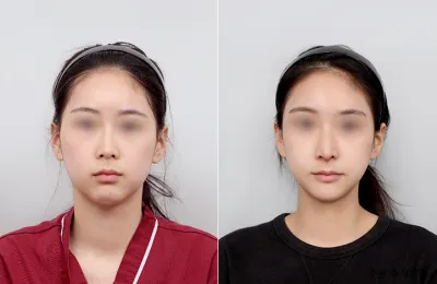 Before & After