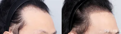 Before & After
