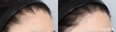 Before & After