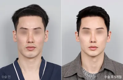 Before & After