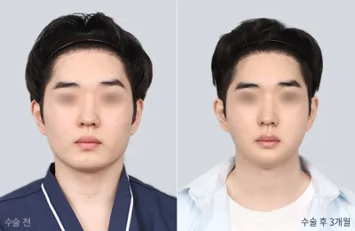 Before & After