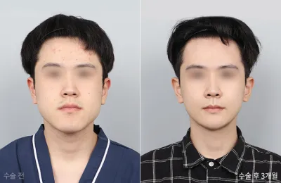 Before & After