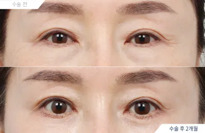 Before & After